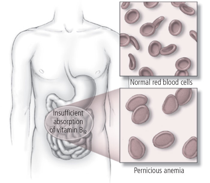 Vitamin B12 deficiency